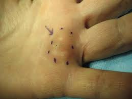 Sebaceous cysts (a misnomer as these cysts are not of sebaceous origin), trichilemmal cysts the you may find the epidermoid and pilar cysts (sebaceous cysts) article more useful, or. Epidermal Inclusion Cyst Hand Orthobullets
