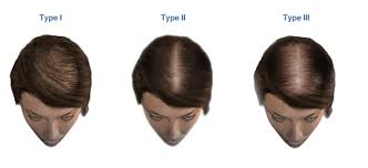 Here, the hair at the top of the scalp becomes thinner. About Baldness Stages Of Alopecia