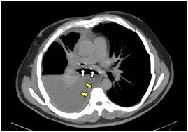 Image result for Lung Abscess