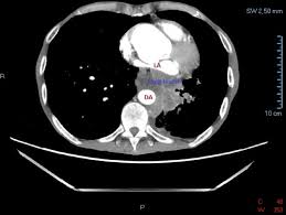In a ct scan, dense substances like bones are easy to see. What Does Lung Cancer Look Like On A Ct Scan With Contrast