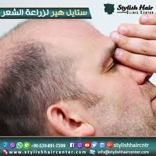 عروض مميزة من هير ستايل في تركيا علي كافة خدماتنا زراعة الشعر باستخدام الميزوثيربي زراعة الشارب واللحية باستخدا hair loss cure hair loss remedies hair loss