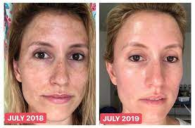 You can check out cosrx triple c lightning liquid (not recommended for sensitive skin). Before After One Year Tretinoin Vitamin C Sunscreen Skincareaddiction Tretinoin Beauty Skin Care Routine Before And After Acne
