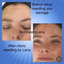 THE BEST 10 Acne Treatment near GALLATIN, TN