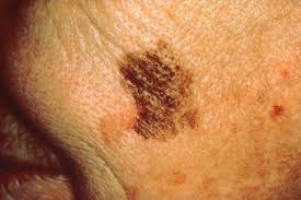 If breast cancer is diagnosed at an early enough stage, it's treatable. Spot The Differences Between A Mole And Skin Cancer