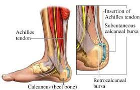One of the most common tendon injuries is often referred to as a bowed tendon, named for the bow shape that develops on the back side of the cannon bone when there is stretching and swelling in the tendon. Achilles Tendon Injury Active Care Physiotherapy Clinic