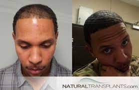 Cost Of A Hair Transplant Will Depend On How Much Hair You Will Want To Be Restored As Well As Hair Transplant Procedure Best Hair Transplant Hair Restoration