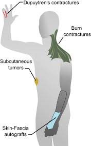 Cutting into wound repair
