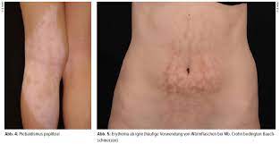 Check spelling or type a new query. Klinisch Diagnostisches Vorgehen Bei Pigmentstorungen Dermatologie Universimed Medizin Im Fokus
