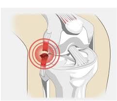 Lateral Knee Pain Diagnosis Treatment Knee Pain Explained