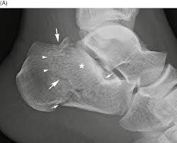 Image result for Calcaneus Compression Fracture