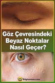 Goz Cevresindeki Beyaz Noktalar Nasil Gecer Gozler Nokta Guzellik