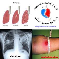 You must finish your medicine and take the drugs exactly as prescribed. Ø£Ø³ÙÙ„ ØªØ¹Ù„ÙŠÙ‚ ÙŠØ§Ø¦Ø³Ø© Ø§Ø®ØªØ¨Ø§Ø± Ù…Ø±Ø¶ Ø§Ù„Ø³Ù„ ØªØ­Øª Ø§Ù„Ø¬Ù„Ø¯ Free4xwebinar Com