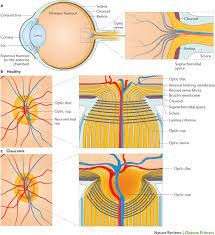 Green graduated from the medical college of georgia at georgia regents university in 1973. Primary Open Angle Glaucoma Nature Reviews Disease Primers
