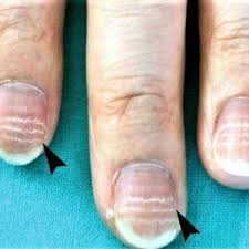 Image result for Beau lines feet