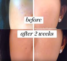 How To Lighten Skin Naturally And Permanently The Everyday Blogger lighten skin naturally and permanently