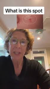 what is this spot? #primarycareprovider #nursepractitioner #medicalstudent  #basalcellcarcinoma #skincancer