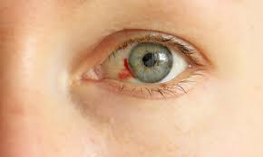 Por Que Aparecen Manchas De Sangre En El Ojo America Noticias