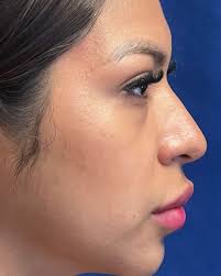 Resultado inicial, apenas 8 días después de cirugía de RINOPLASTIA