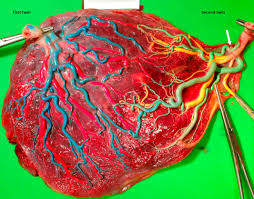 Term sometimes used synonymously with marginal cord insertion; Velamentous Cord Insertion In Dichorionic And Monochorionic Twin Pregnancies Does It Make A Difference Sciencedirect