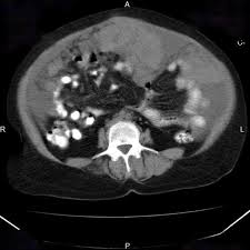 Peritoneal mesothelioma affects the lining of the abdominal organs. Peritoneal Cancer Cancerwalls