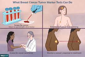 Many women find help dealing with. Breast Cancer Tumor Marker Tests