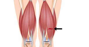In quadrupeds, the hamstring is the single large tendon found behind the knee or comparable area. Hamstring Strain Pulled Hamstring Sportsinjuryclinic Net