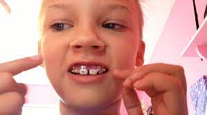 Why to use rubber bands with braces? Orthodontists Warn Against Homemade Braces Ctv News