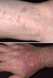 This material is provided for educational purposes only and is not intended for medical advice, diagnosis or treatment. Lichen Ruber Planus Knotchenflechte Hauterkrankungen Msd Manual Ausgabe Fur Patienten