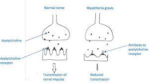 Myasthenia Gravis And Pregnancy Wfsa Resources