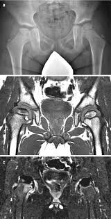 Legg Calve Perthes Disease Diagnosis Imaging And Classifications Springerlink
