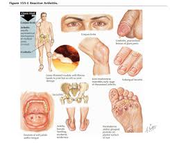 If unaccompanied by other signs and symptoms, the eye abnormalities are referred to as rieger eye anomalies. M Y W A Y On Twitter Reiter Syndrome Features Pick Gun Planter Fascitis Inflamed Joints Conjunctivitis Circinate Balanitis Keratoderma Blenorrhagia Gum Ulceration Urethritis Nail Dystrophy