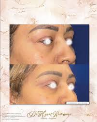 Piel excedente en los párpados? Deseas mejorar el aspecto de tu mirada,  tienes piel redundante en tus párpados, bolsas prominentes y prolapsadas, y  esto hace que sean muy notorias las ojeras. tal