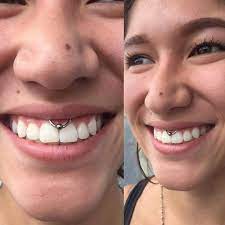 Smiley Piercing Amazing Photos And Important Information Tats N Rings Smiley Piercing Smilie Piercing Piercing
