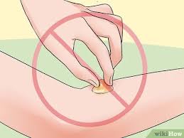 Eine Blase Aufstechen 14 Schritte Mit Bildern Wikihow