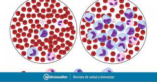La leucemia es un cáncer de los glóbulos blancos. Tipos De Leucemia Salud Al Dia