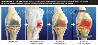 Water on the knee is characterized by the accumulation of fluid and inflammation around the knee joint. Treating Chronic Knee Swelling Knee Synovitis And Inflammation Without Anti Inflammatory Medication Caring Medical Florida