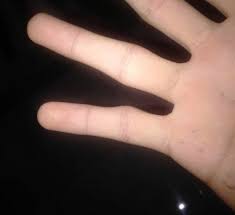 Others suggest that smartphone pinky may be a temporary finger position that goes away over time, once the person stops holding their phone in the same position. 7 Types Of Smartphone Injuries And How To Avoid Them