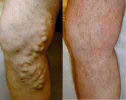 Membrelor boala varicoasă în orașul barnaul cât de mult o intervenție chirurgicală clinica moderna specializata in tratamentul varicelor. Tratament Varice Cluj Operatii Laser Varice Medestet Cluj