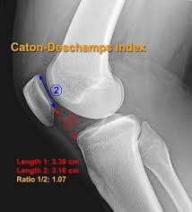 There are various muscles that control movement, ligaments that. Patella Alta Physiopedia