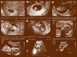 We serve 30,000 women annually from 33 centers in 11 states, including illinois, indiana, kentucky, maryland, michigan, minnesota, nebraska, north dakota, ohio, pennsylvania & wisconsin. Gender Ultrasound Are You Having A Boy Or Girl Parents