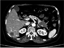 Ima 33y/o male ive been having oily stools for almost 5 months,weight loss of almost 50 lbs total despite having a healthy appetite,mild but constant middle to lower back pain,constant burping and bloated have had 2 abdominal ct scans one without contrast and. Comparison Of The Chemosensitivity Of The Primary Lesion And A Pancreatic Metastasis Of Colon Cancer A Case Report Anticancer Research