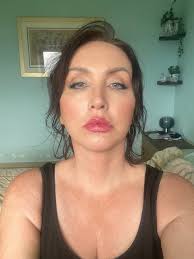 Just so everyone knows--Dr. Mascaro of Fifth Ave Plastic Surgery, Delray  Beach, FL, is booking consults 18 months out, so Nov, 2026. But more  importantly, his estimate for a brow-, face- and