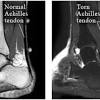 Cerebrospinal fluid oligoclonal bands in multiple sclerosis and clinically isolated syndromes: Https Encrypted Tbn0 Gstatic Com Images Q Tbn And9gcqdk8q2z3v3d8yuymznx3yyqimj8 Gvxs6ob21i Vkfft Fhz2g Usqp Cau
