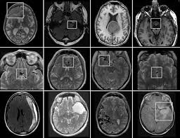 Image result for Incidental Imaging Finding