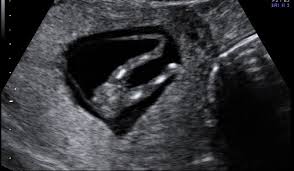 Geschlecht 14 Ssw Schwangerschaftsgruppe Babycenter