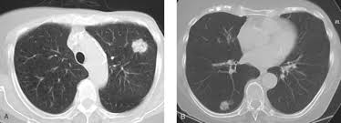 However, multidetector computed tomography (ct) often provides the first images of the breast when scanning is performed for pulmonary or cardiac disease. Thoracic Metastases Mimics And Treatment Effects Clinical Gate