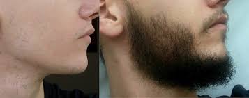 As an icing to the cake, there is the study by dhurat et al. Pin On Beardstuff