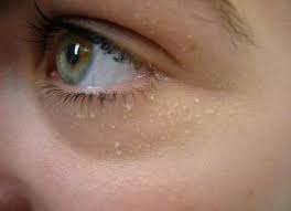 If Little White Spots Appear On Your Skin It Probably Means This With Images Bumps Under Eyes White Bump On Eyelid White Bumps On Face