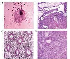 Image result for Chorioamnionitis
