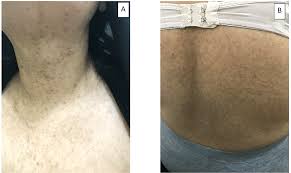 Image result for Diffuse Hyperpigmentation